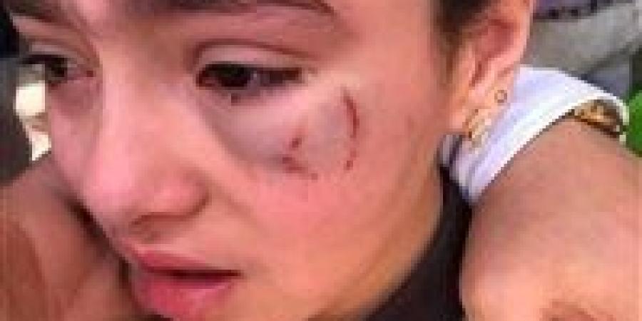 تصالح بين أسرة الطفلة “حنين” والمعلم بعد إصابتها في عينها داخل مدرسة بالدقهلية